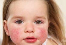 Аллергия на продукты у ребенка