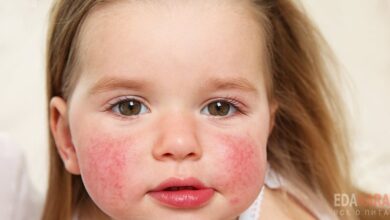 Аллергия на продукты у ребенка