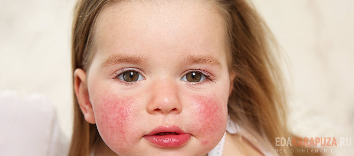 Аллергия на продукты у ребенка